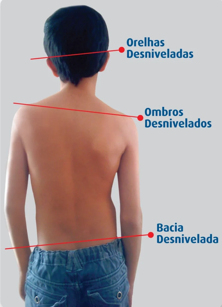 Desnivelamento Uma visita ao quiroprático